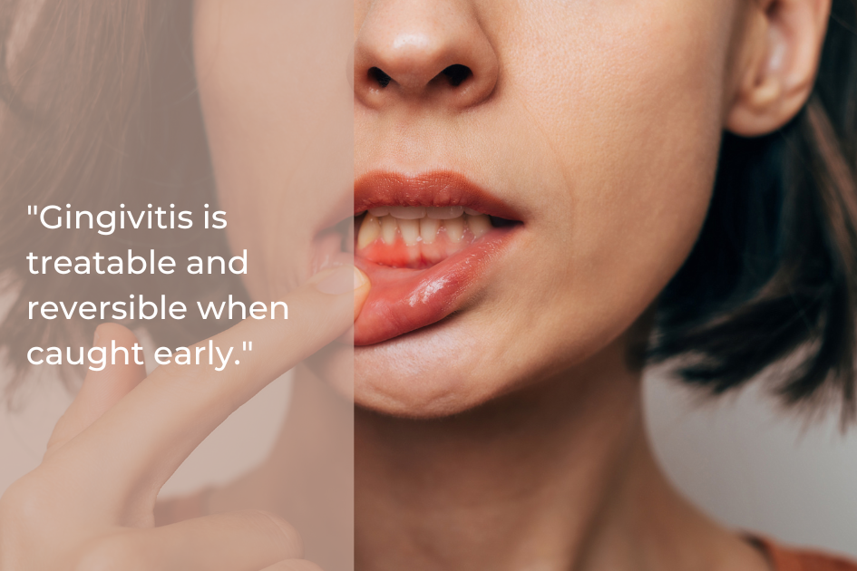 A person pulling down their lower lip to show their gums, with a quote about gingivitis being treatable and reversible when caught early.
