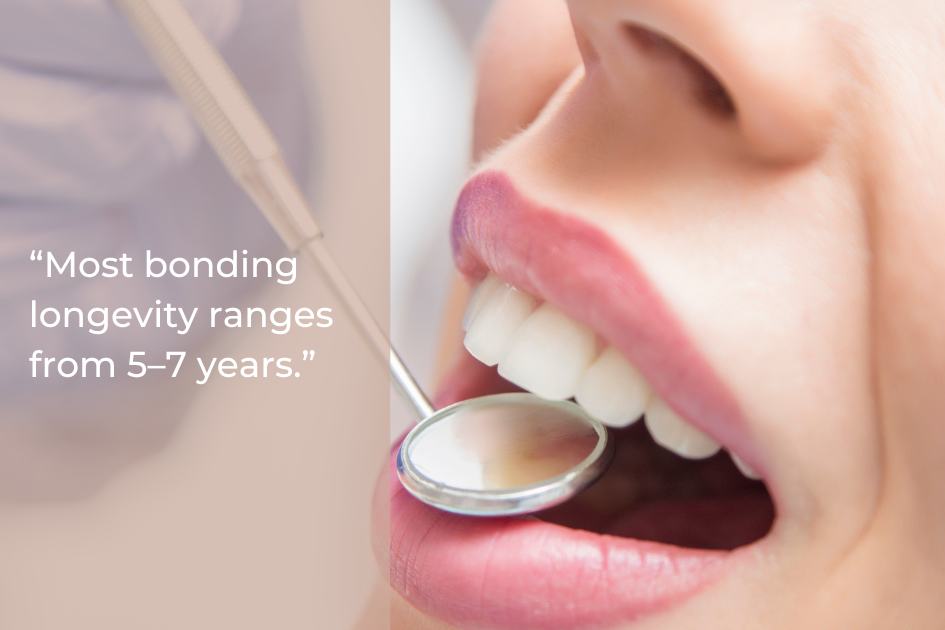 A dental mirror and tool examine a person's teeth; text states, "Most bonding longevity ranges from 5–7 years.